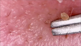 Worst Pops Cysts Zits Pimples amp Blackhead Popping [upl. by Giuliana768]