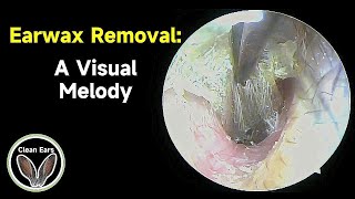 Cerumen Removal A Visual Melody [upl. by Huxley]