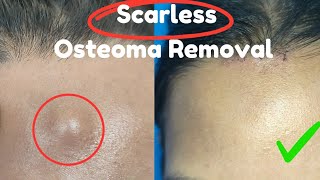 Scarless Osteoma Removal Bony swelling removal from forehead Best osteoma Removal [upl. by Cele218]