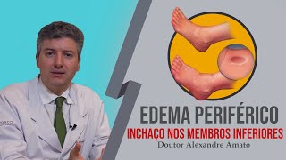 Inchaço nas pernas Edema periférico [upl. by Dolhenty216]