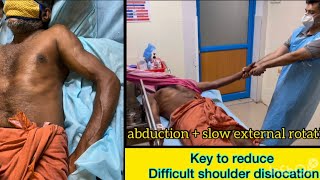 Anterior shoulder dislocation Reduction Technique amp Principles  key for reduction Modified Milch🔥 [upl. by Alurd428]