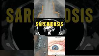 SARCOIDOSIS  CASO CLÍNICO MedicinaMedEdMédicoSaludRadiologíaCasoClínicoEducaciónMédica [upl. by Neemsay165]