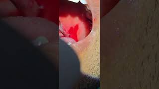 Quinsy Peritonsillar abscess incision and drainage  Dr Hitesh Patel [upl. by Burgwell572]