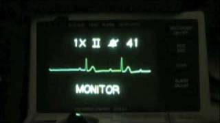 Vital Ethics ACLS ECG Recognition Sacramento [upl. by Stephine]