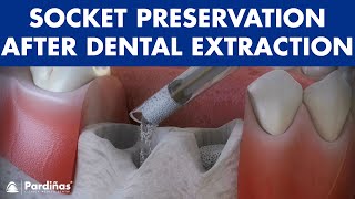 Tooth extraction  Treatment for socket preservation © [upl. by Lynnett]