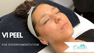 VI Peel®  Chemical Peel for Hyperpigmentation [upl. by Baniez103]