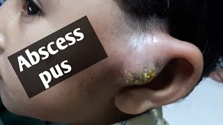 Massive abscess near left ear  pus expulsion  preauricular sinus infection  👍👍🙏 [upl. by Humble197]