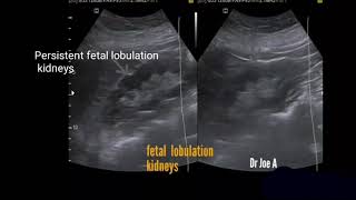 Persistent fetal lobulation kidney ultrasound video [upl. by Nnoved]