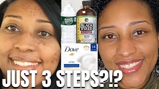 FADE Hyperpigmentation in Black Skin in 3 EASY Steps [upl. by Ehlke]