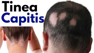 Tinea capitis symptoms treatment  Ringworm of scalp  tinea capitis scalp treatment [upl. by Annmaria]