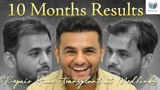 10 Months Repair Hair Transplant Results  4000 Grafts  Medlinks Dr Gaurang Krishna Reviews [upl. by Lily]