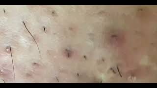 ASMR Extraction ingrown hair  Tweezer  Hair removal Pluck hair [upl. by Allac]