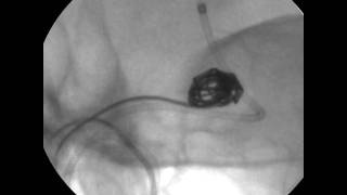 Use of the MicroAngiographic Fluoroscope for Coiling of Intracranial Aneurysms Video 2 [upl. by Leemaj]