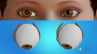 How is strabismus surgery done [upl. by Esiuolyram]