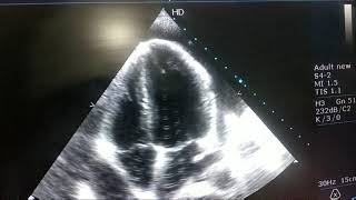 CARDIAC TAMPONADE ECHO APICAL FOUR CHAMBER VIEW [upl. by Leynad475]