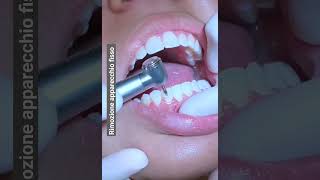 Rimozione apparecchio fisso dai denti  rimozione dei brackets ortodontici [upl. by Aninotna876]