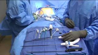 Single Site Laparoscopic Cholecystectomy  Introduction and Instruments [upl. by Nicolette]