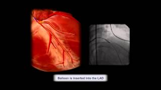 Cardiac Tamponade from PCI resulting in death due to failure [upl. by Yednarb517]