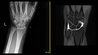 What is an MRI wrist arthrogram [upl. by Charil]