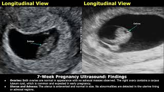 7 Week Pregnancy Obstetric Ultrasound Report Example  Normal Intrauterine Pregnancy USG Reporting [upl. by Sumetra]