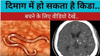 NCC  Neurocysticercosis  दिमाग में कीड़ा न्यूरोसिस्टीसर्कोसिस [upl. by Gwen408]