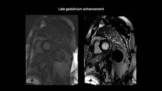 How to assess myocarditis with the help of cardiac MRI CMR [upl. by Gail]