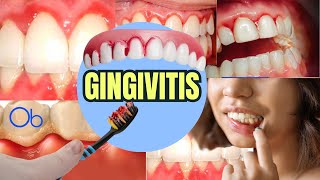 GINGIVITIS qué es síntomas y tratamiento [upl. by Eussoj732]