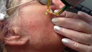 Laser treatment for facial thread veins with Candela NdYag laser [upl. by Hanny]