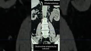 Obstructive uropathy ureteric calculus kidneystone ctscan renalfailure s9teleradiology [upl. by Yojal]