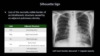 How to Interpret a Chest XRay Lesson 8  Focal Lung Processes [upl. by Lamarre]