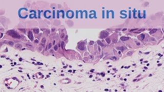 What is Carcinoma in situ  Pathology mini tutorial [upl. by Sleinad]