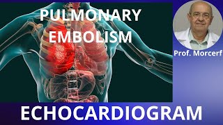 Pulmonary Embolism All Echocardiogram Signs [upl. by Adonis730]