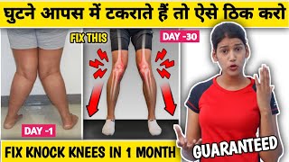 Correct Knock Knees In 1 Month EFFECTIVE Exercises To Fix Knock Knees For Forever [upl. by Raffo]