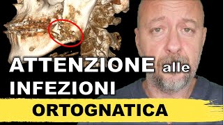 ATTENZIONE alle INFEZIONI in chirurgia ortognatica [upl. by Enytsirk]