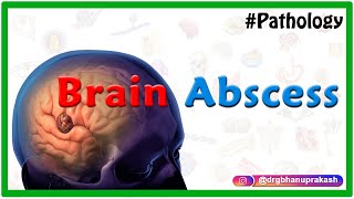 Brain abscess Pathology  Etiology  Pathogenesis  Clinical manifestations  Diagnosis amp Treatment [upl. by Malinin]