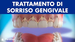 Gengivectomia  Trattamento di sorriso gengivale © [upl. by Fanni]