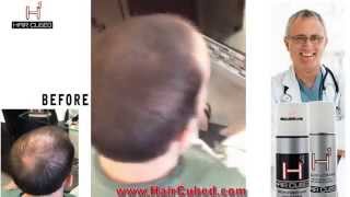 Thinning Hair Problem  New Solution for Hair Loss HAIR CUBED® [upl. by Ecyaj]