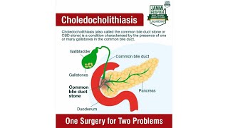 One Surgery for Two Procedures  Laparoscopic Cholecystectomy with Choledocholithotomy  Dr GS Jammu [upl. by Ym]