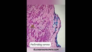 71mhemicolectomycolon adenocarcinoma msi serosa T4 metastasis frcpath elearningfrcpathcom [upl. by Mcmahon174]