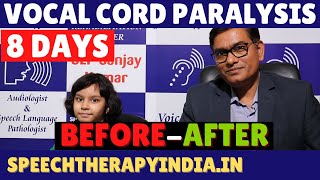 BeforeAfter  Unilateral Vocal Cord Paralysis Phonatory Gap  8 Days Treatment  slpsanjaykumar [upl. by Riggall]