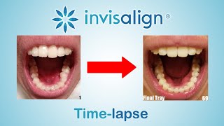 Invisalign Full Timelapse [upl. by Albert]