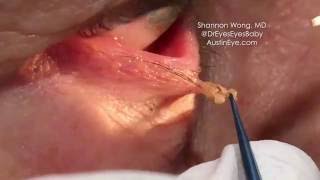 Excision of eyelid papilloma 91216 Shannon Wong MD [upl. by Alathia]