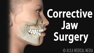 Corrective Jaw Orthognathic Surgery Animation [upl. by Assiluy]