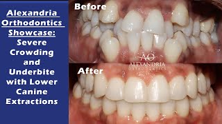 Alexandria Orthodontics Showcase Severe Crowding and Underbite with Lower Canine Extractions [upl. by Zins118]