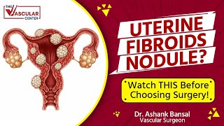 Uterine Fibroid Treatment in Mumbai  Without Surgery  Uterine Artery Embolization Explained [upl. by Hulton786]