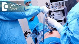 What is the advantage of Laparoscopy Surgery  Dr Nupur Sood [upl. by Kragh]