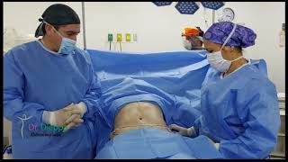 Cirugía Abdominal Abdominoplastia con Lipoescultura [upl. by Raji708]