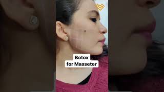 Botox for Masseter helps with TMJ Grinding Jawline Slimming Clenching [upl. by Nepean]