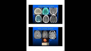 NEUROCYSTICERCOSIS [upl. by Tse]