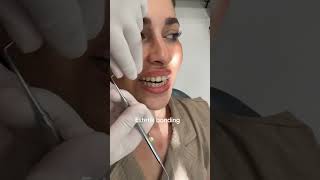 Bonding dolgu laminediş veneergigi dentalclinic zirkonyumkaplama [upl. by Elwin]